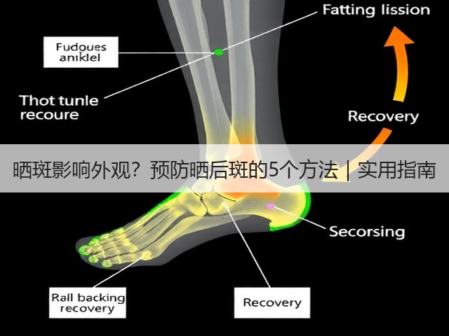 晒斑影响外观?预防晒后斑的5个方法|实用指南(图2) 晒斑影响外观?预防晒后斑的5个方法|实用指南(图2)